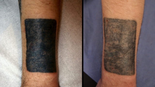 At Home Tattoo Removal As A Substitute For Expensive Laser Removal Methods