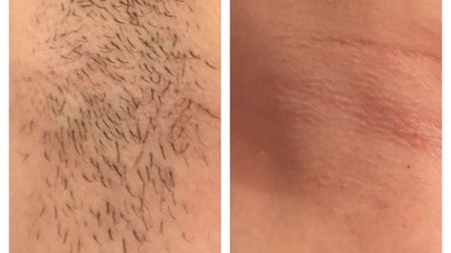 Say Goodbye to Unwanted Hair! Exploring the World of Laser Hair Removal