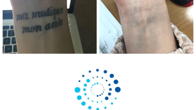 Low Cost Tattoo Removal – Your Solution With Regard To An Unwanted Tattoo