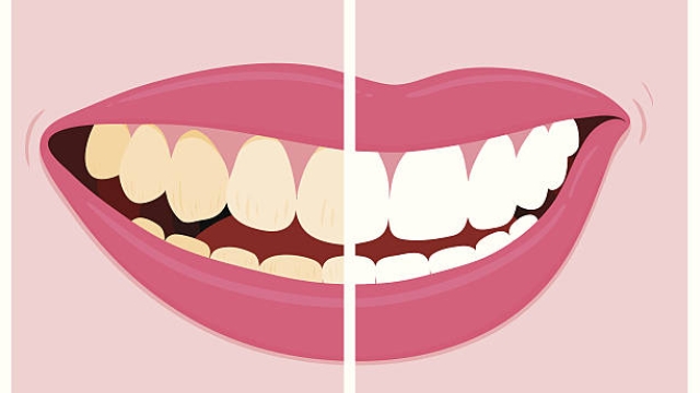 Shine Bright: The Ultimate Guide to Teeth Whitening